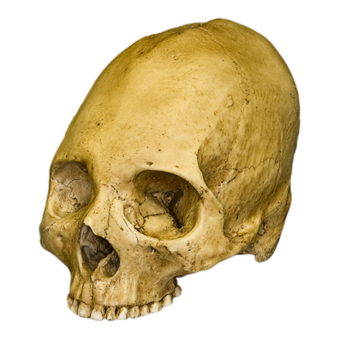 Replica Human Skull - Trephined