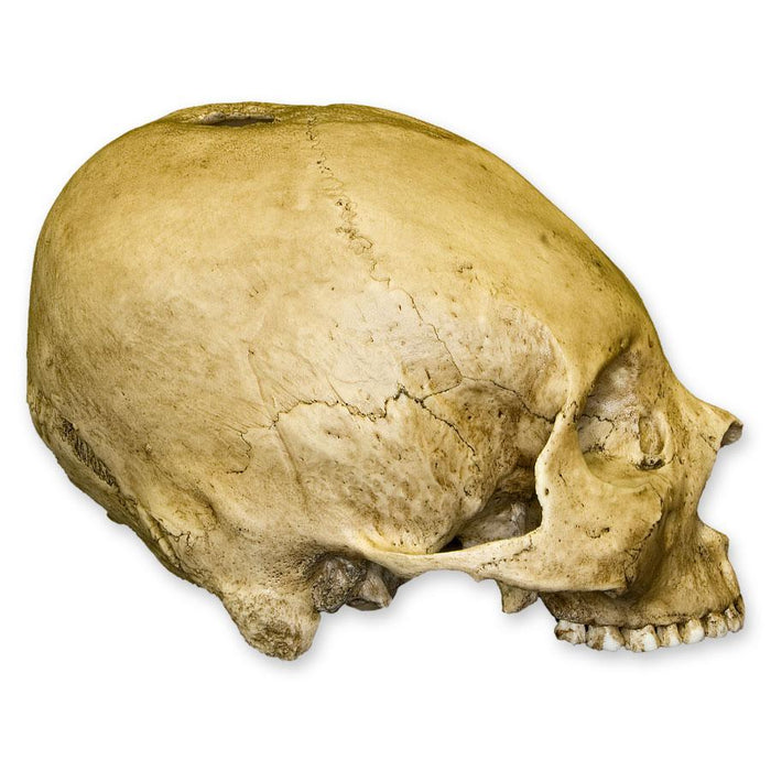 Replica Human Skull - Trephined