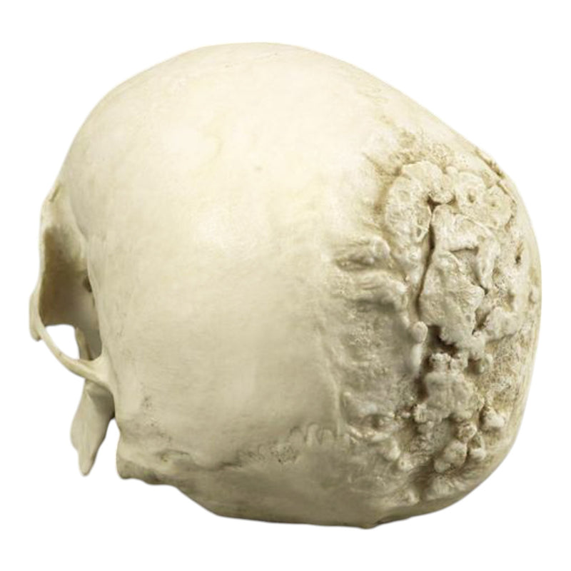 Replica Human Skull with Syphilis