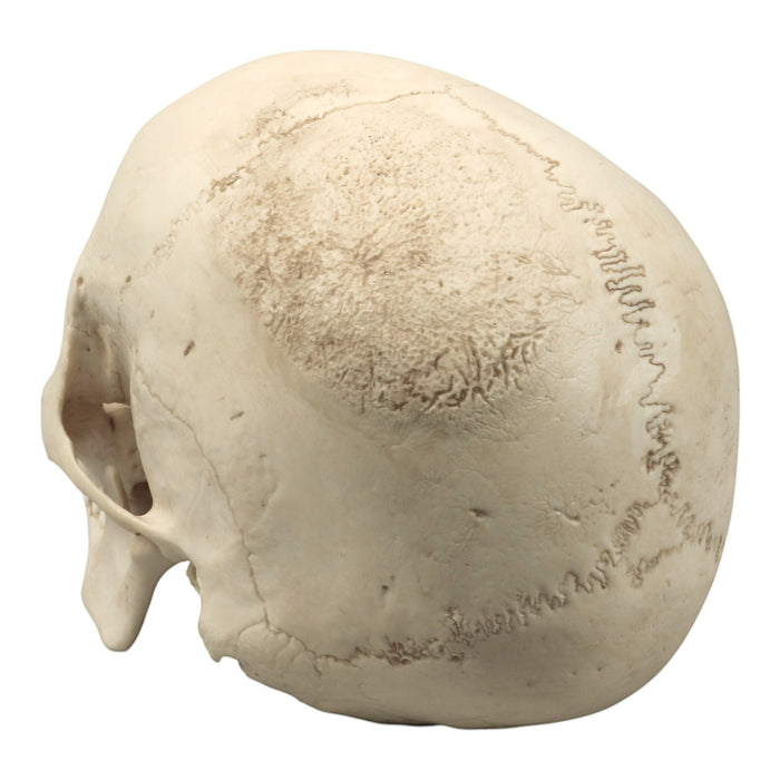 Replica Human Skull - Porotic Hyperostosis and Cribra Orbitalia
