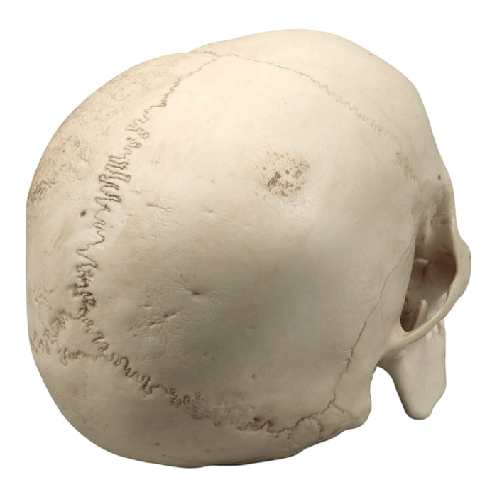 Replica Human Skull - Porotic Hyperostosis and Cribra Orbitalia