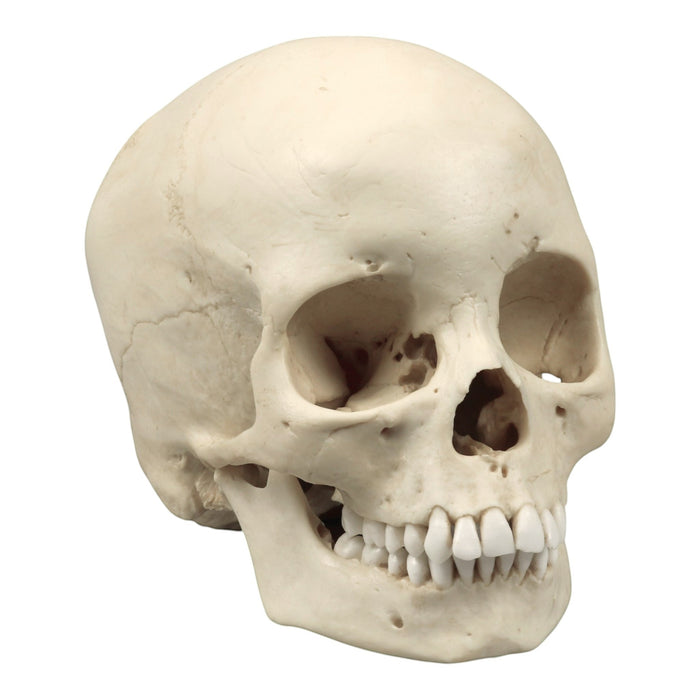 Replica Human Skull - Porotic Hyperostosis and Cribra Orbitalia