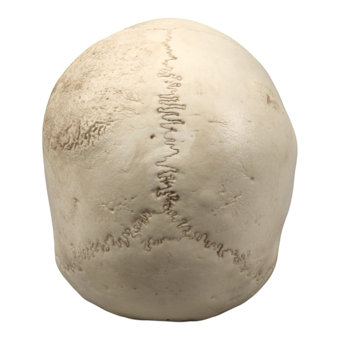 Replica Human Skull - Porotic Hyperostosis and Cribra Orbitalia