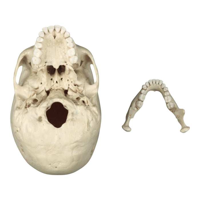 Replica Human Skull - Porotic Hyperostosis and Cribra Orbitalia