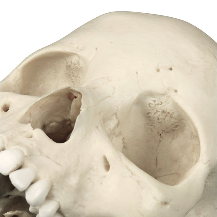 Replica Human Skull - Porotic Hyperostosis and Cribra Orbitalia