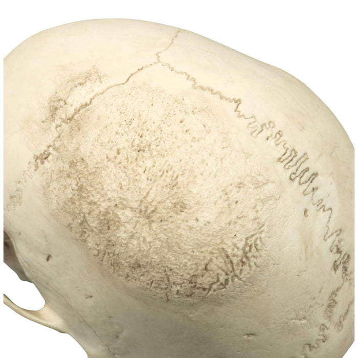Replica Human Skull - Porotic Hyperostosis and Cribra Orbitalia