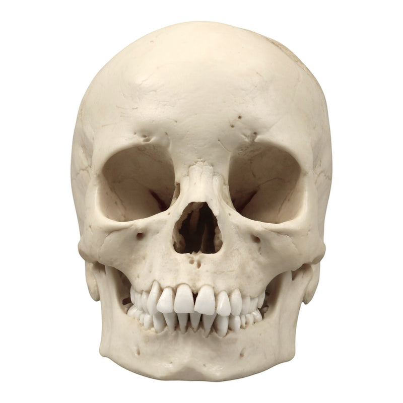 Replica Human Skull - Porotic Hyperostosis and Cribra Orbitalia