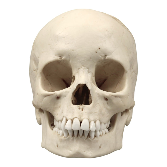 Replica Human Skull - Porotic Hyperostosis and Cribra Orbitalia