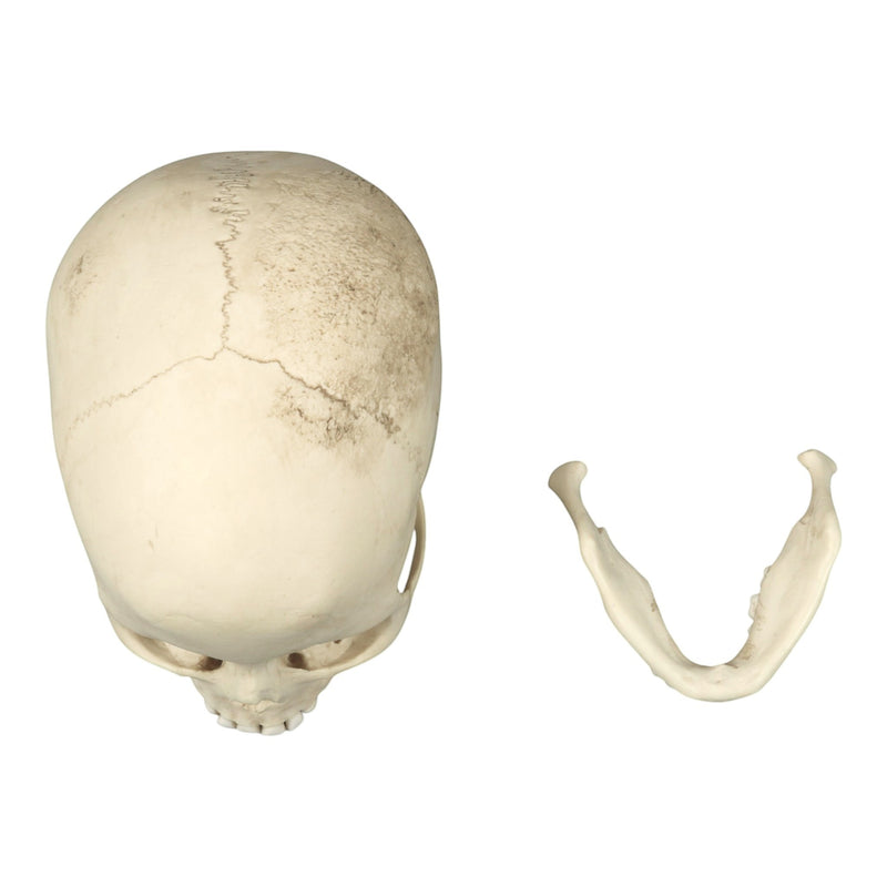 Replica Human Skull - Porotic Hyperostosis and Cribra Orbitalia
