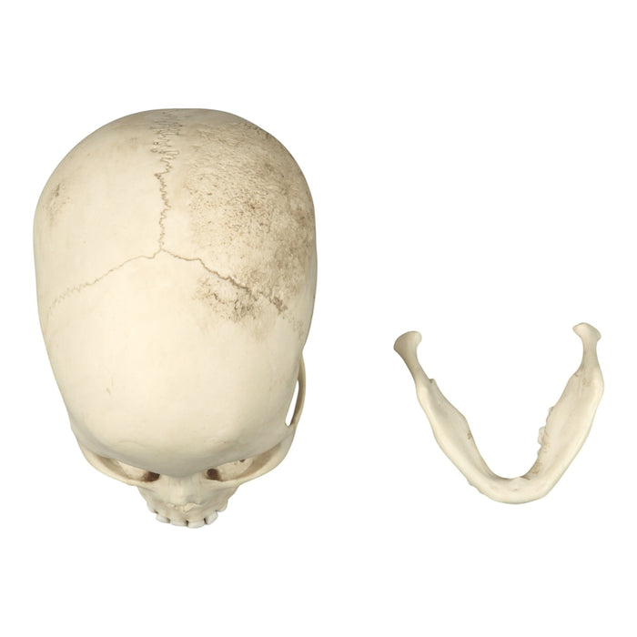 Replica Human Skull - Porotic Hyperostosis and Cribra Orbitalia