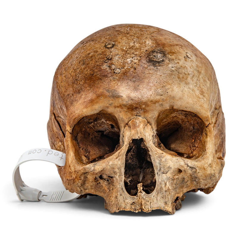 Real Human Skull - No Mandible