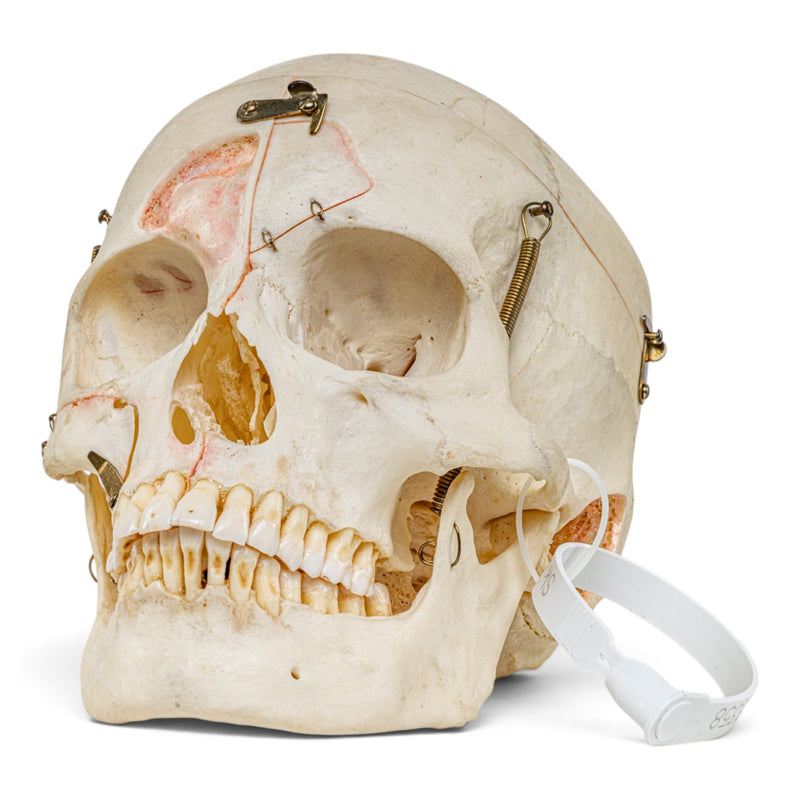 Real Human Skull - Dissected - with Carrying Case