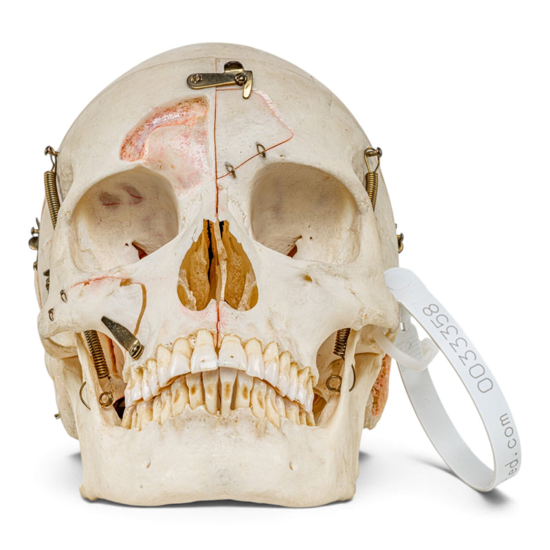 Real Human Skull - Dissected - with Carrying Case