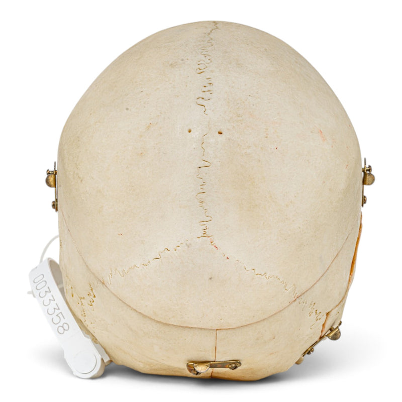 Real Human Skull - Dissected - with Carrying Case