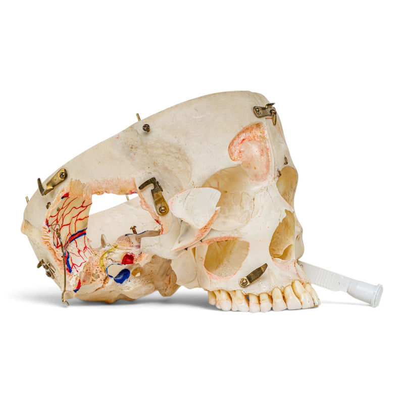 Real Human Skull - Dissected - with Carrying Case