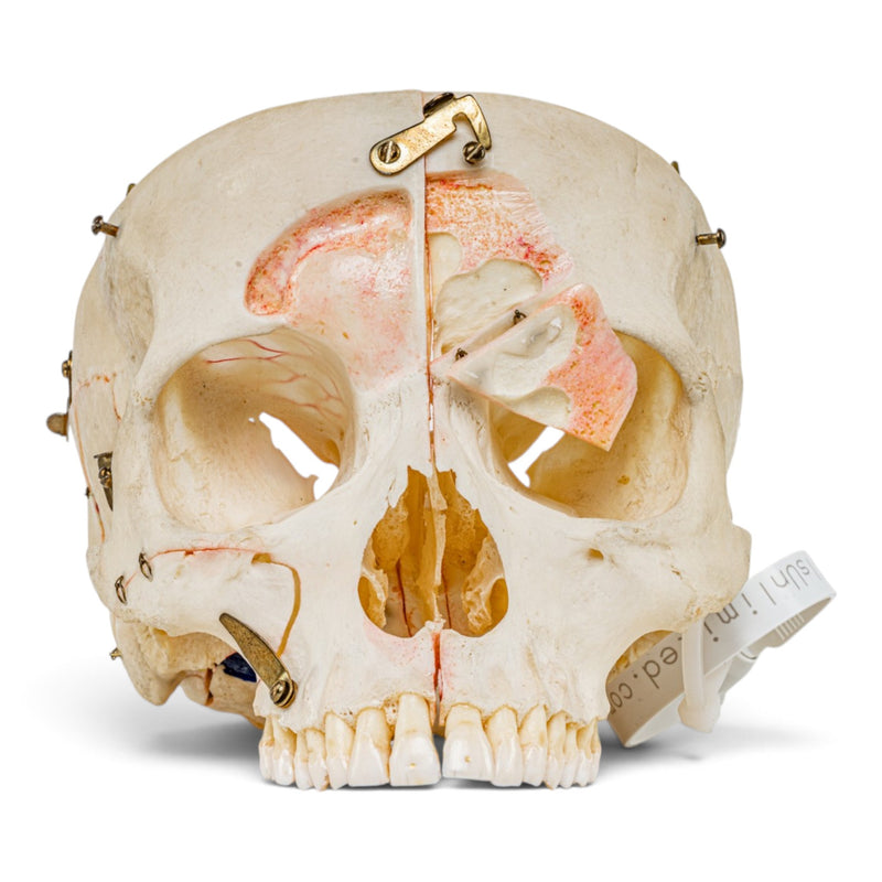 Real Human Skull - Dissected - with Carrying Case