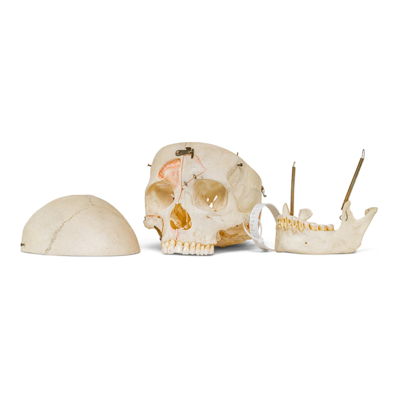 Real Human Skull - Dissected - with Carrying Case