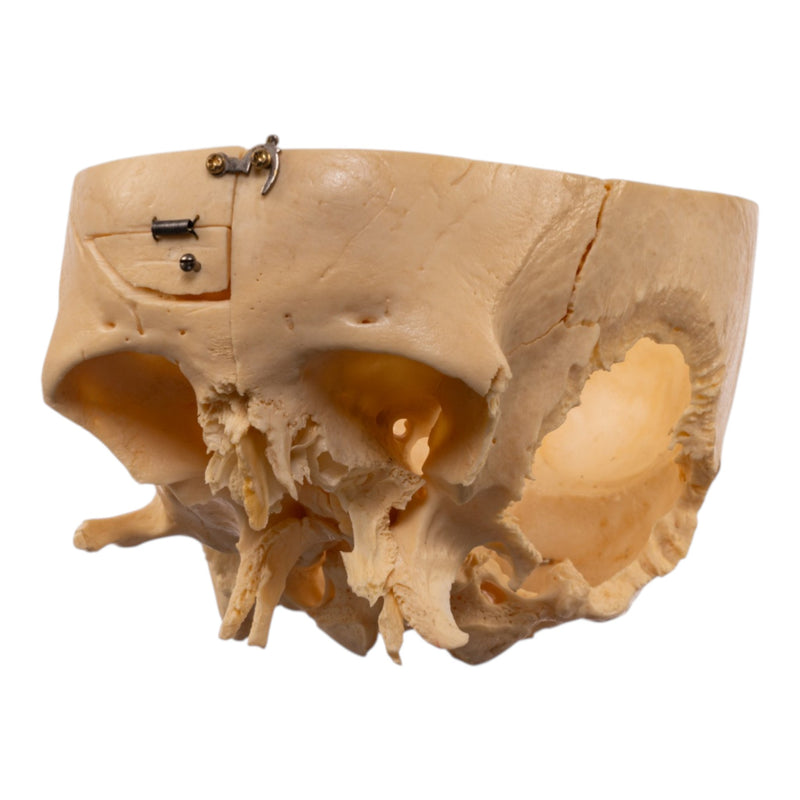 Real Human Partial Skull - Dissected
