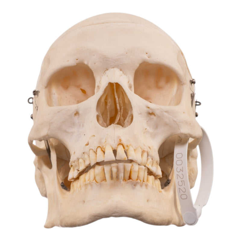 Real Human Skeleton - Disarticulated