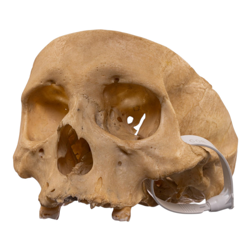 Real Human Partial Skull