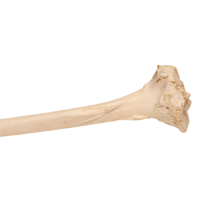 Real Human Left Tibia - Pathology
