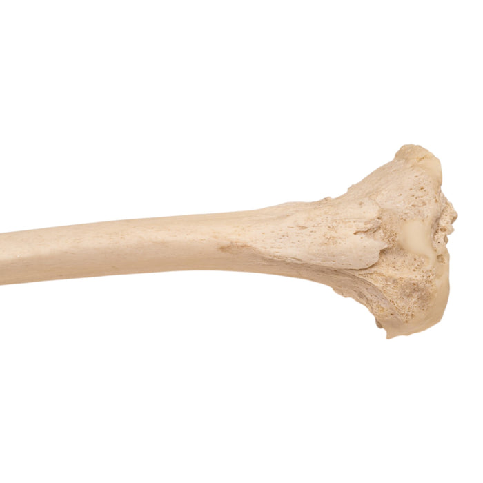 Real Human Left Tibia - Pathology