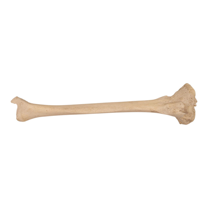 Real Human Left Tibia - Pathology