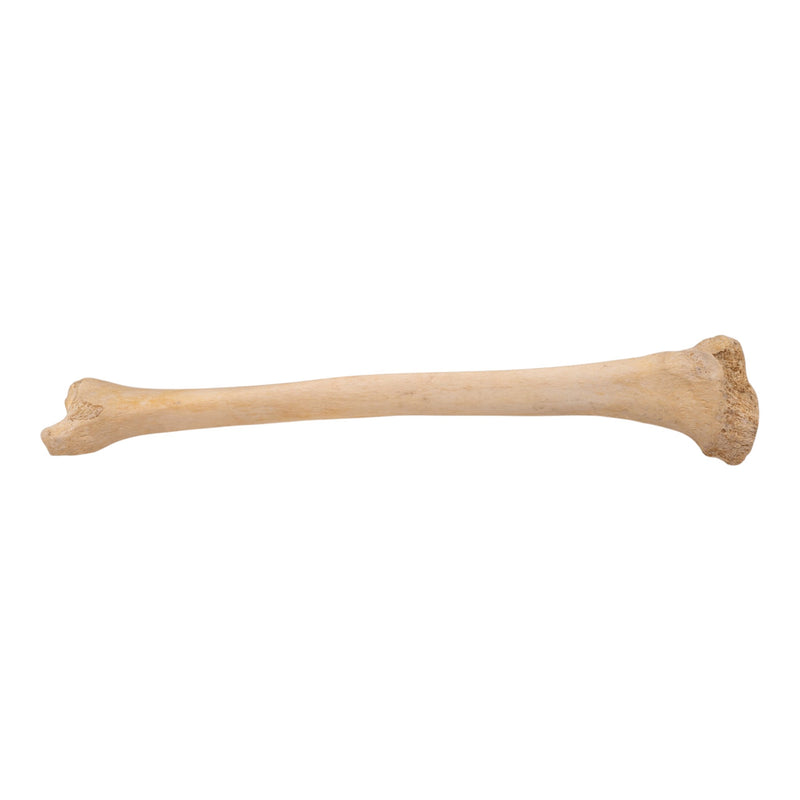 Real Human Tibia - Pathology