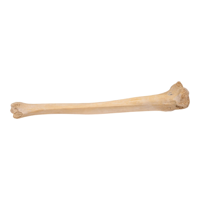 Real Human Tibia - Pathology