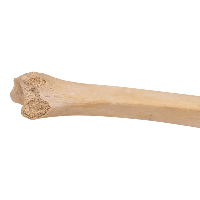 Real Human Tibia - Pathology
