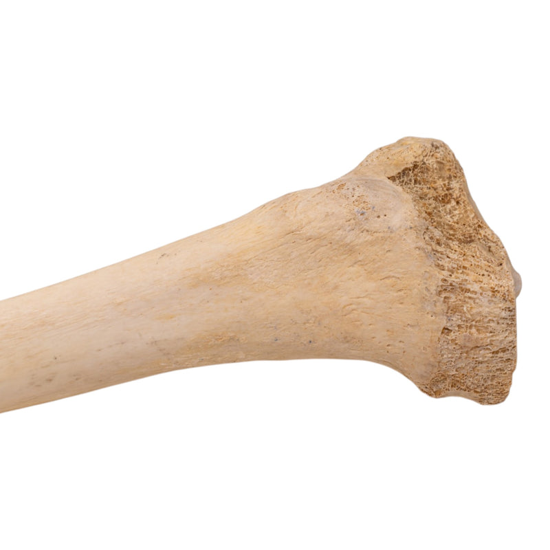 Real Human Tibia - Pathology