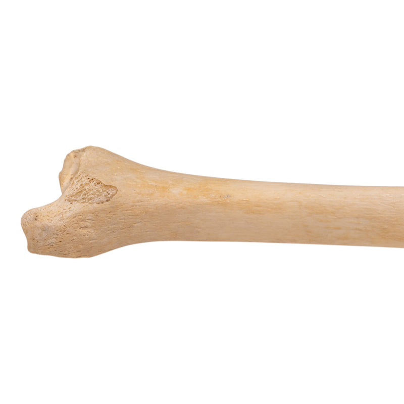 Real Human Tibia - Pathology