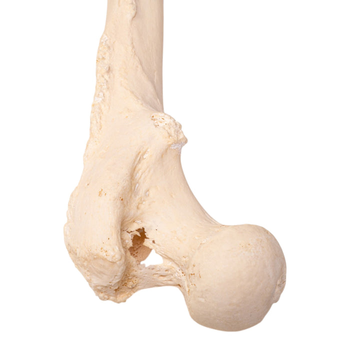 Real Human Femur - Pathology