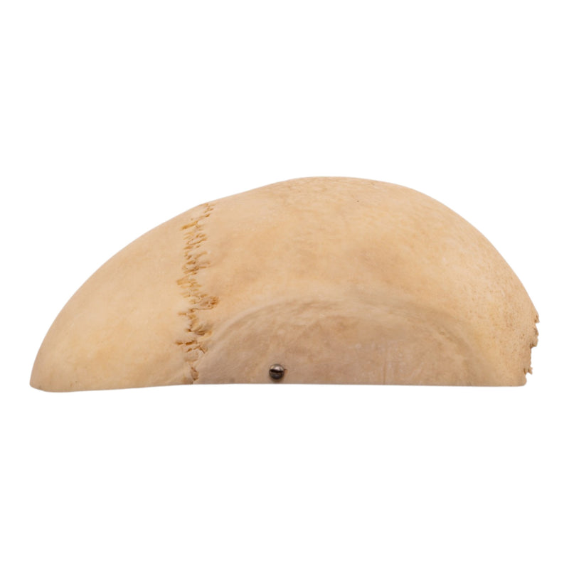 Real Human Calvaria with Hardware