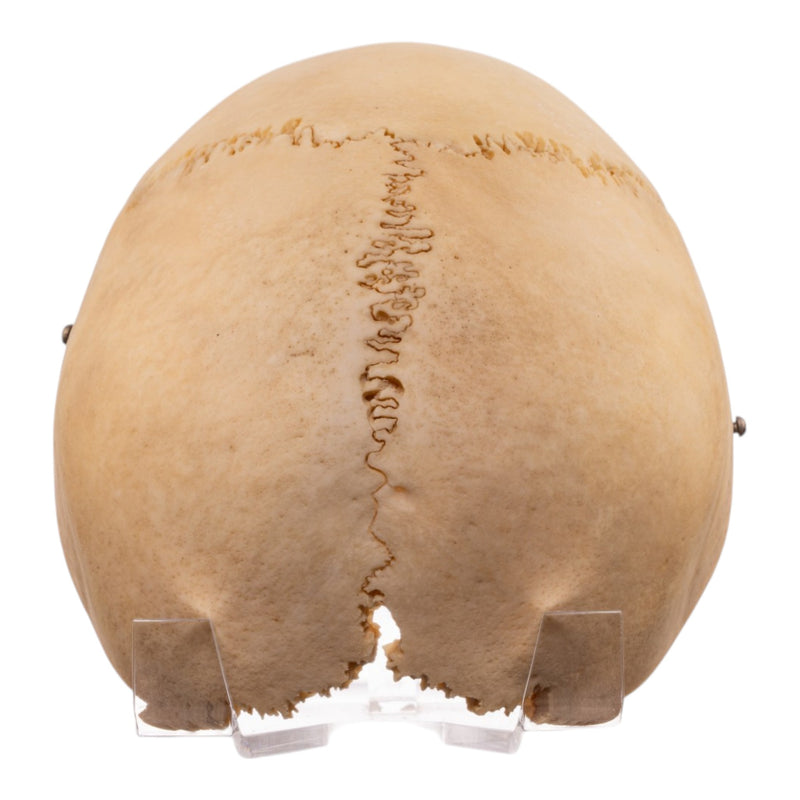 Real Human Calvaria with Hardware