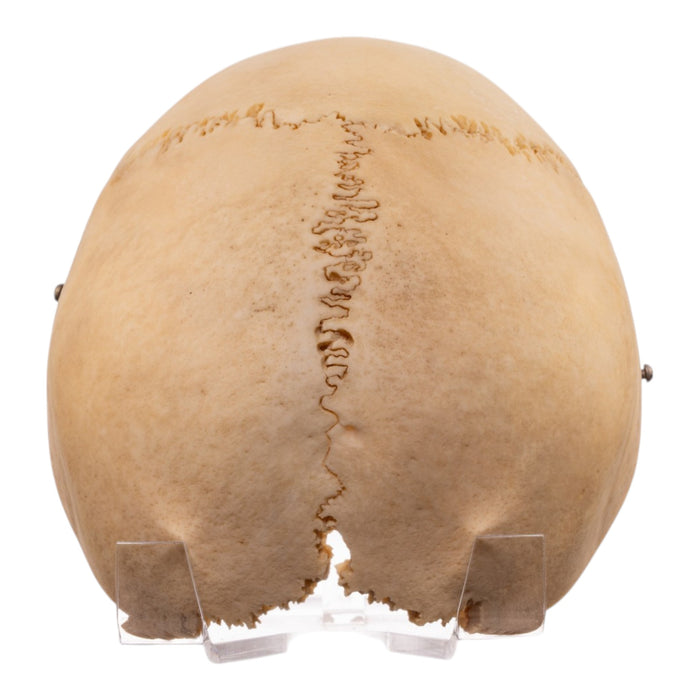 Real Human Calvaria with Hardware