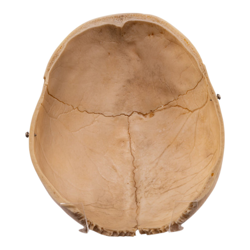 Real Human Calvaria with Hardware