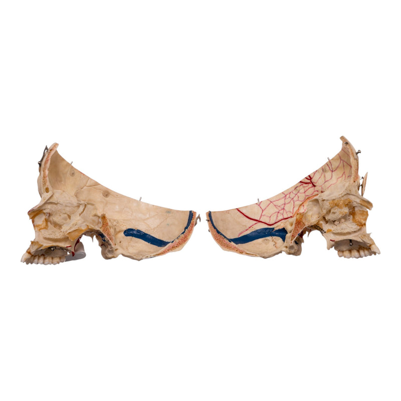 Real Human Dissected Skull in Carrying Case