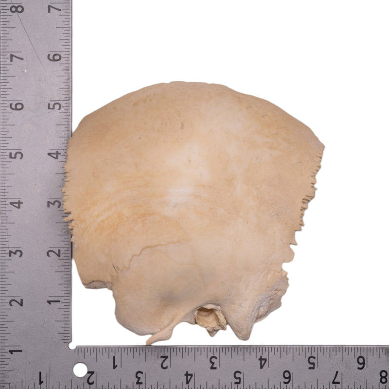 Real Human Fused Parietal and Temporal Bone