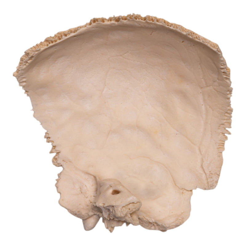 Real Human Fused Parietal and Temporal Bone
