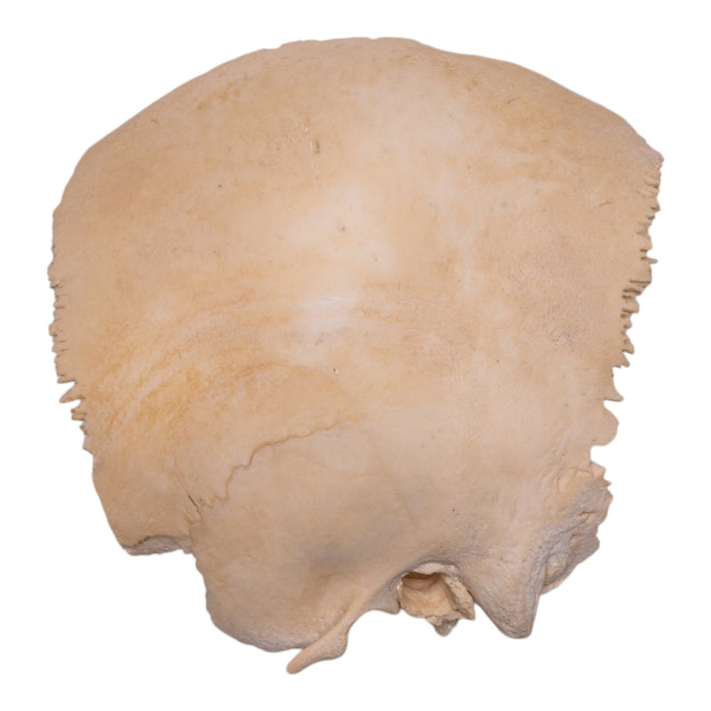 Real Human Fused Parietal and Temporal Bone