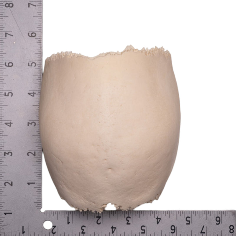 Real Human Partial Cranial Vault