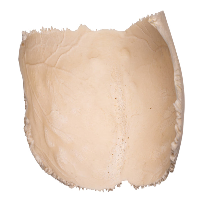 Real Human Partial Cranial Vault