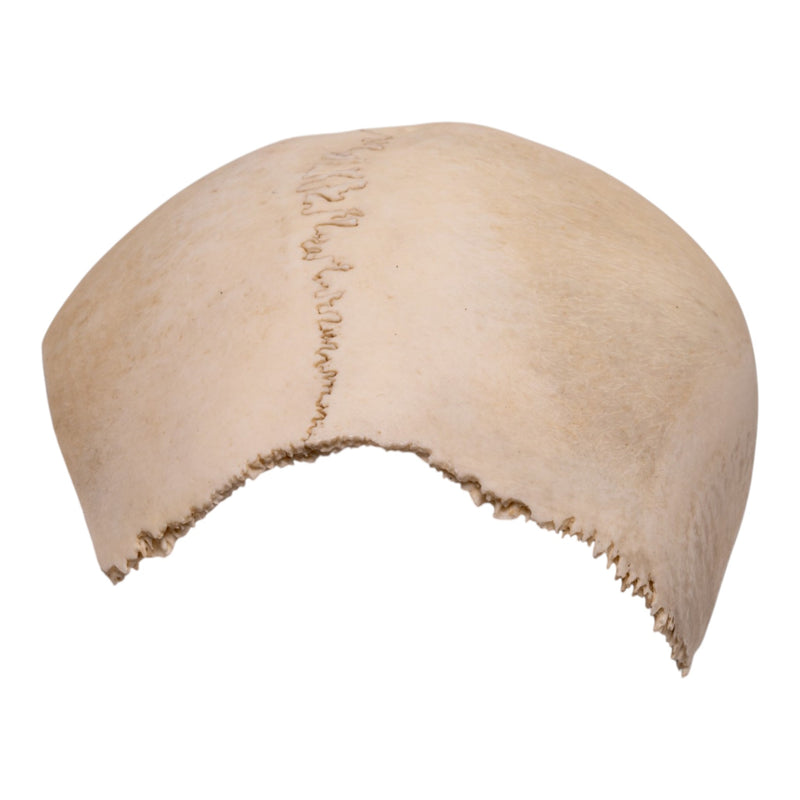 Real Human Partial Cranial Vault