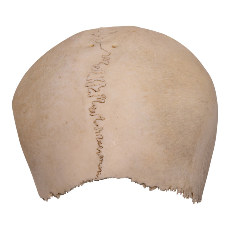 Real Human Partial Cranial Vault