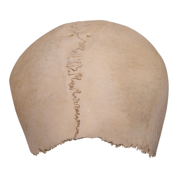 Real Human Partial Cranial Vault