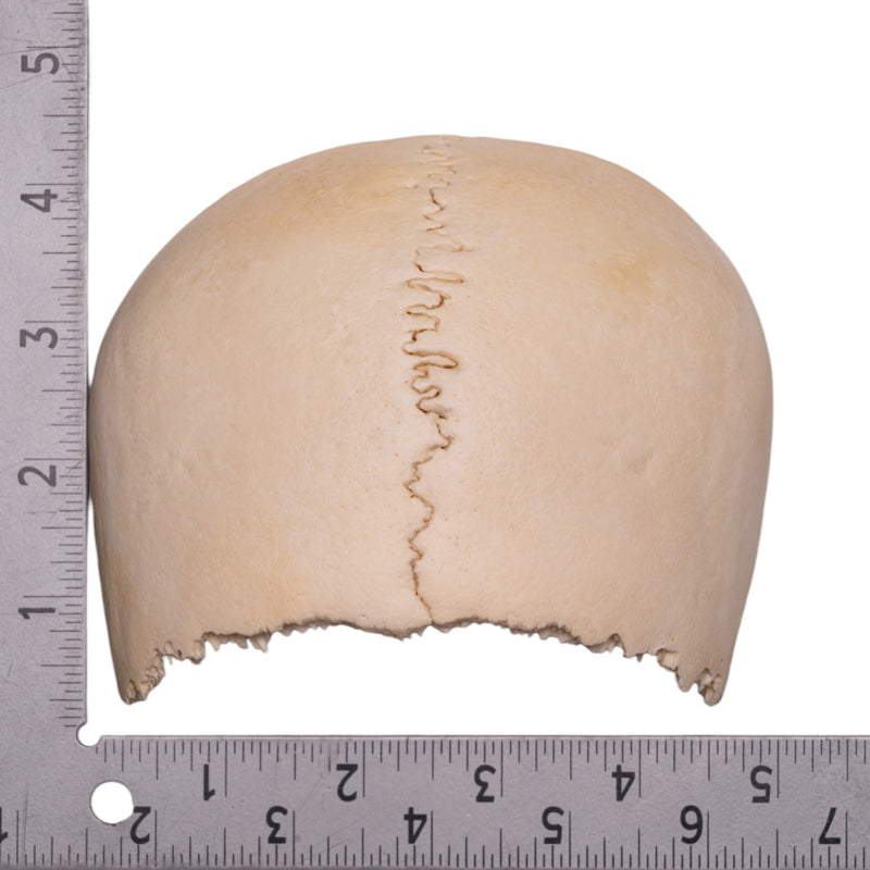 Real Human Partial Cranial Vault