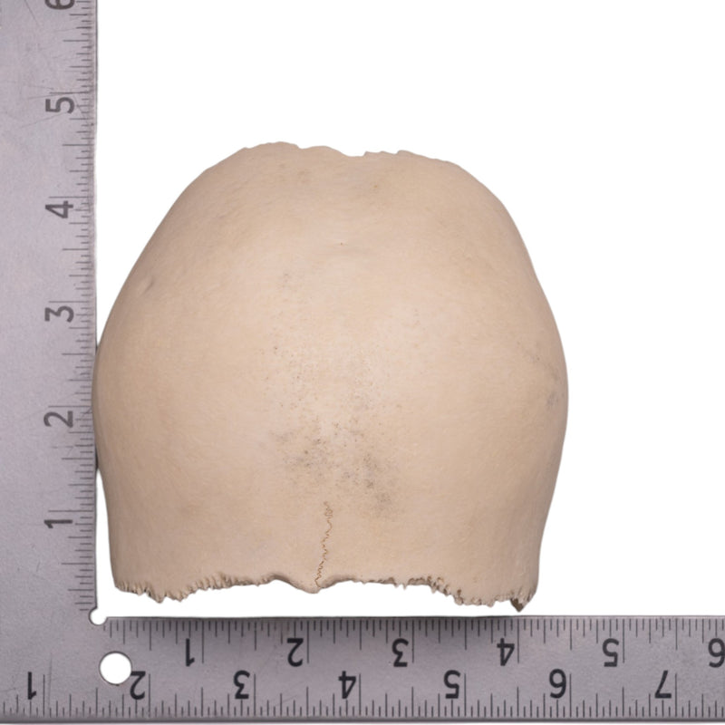 Real Human Partial Cranial Vault