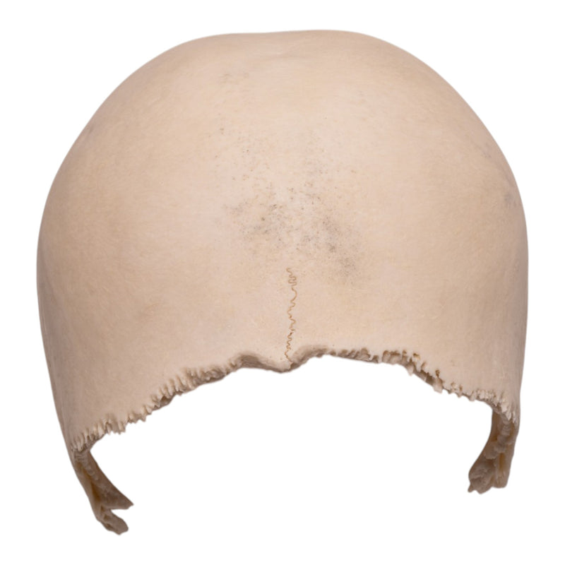 Real Human Partial Cranial Vault