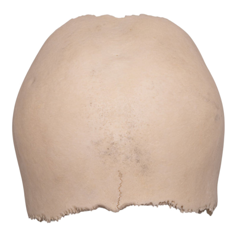 Real Human Partial Cranial Vault